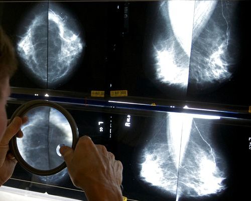 Breast Density & Mammography, NJ